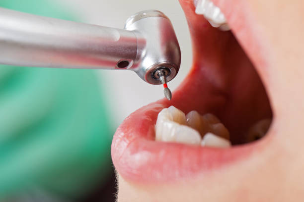 Best Emergency Tooth Extraction in Paducah, TX
